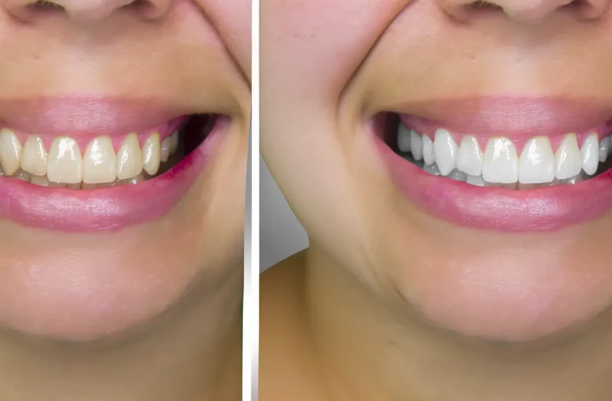 Cómo Quitar lo Amarillo de los Dientes: Sonrisa Radiante en Pasos Sencillos